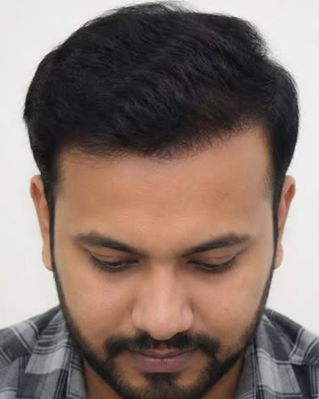 After, hairline and crown restoration