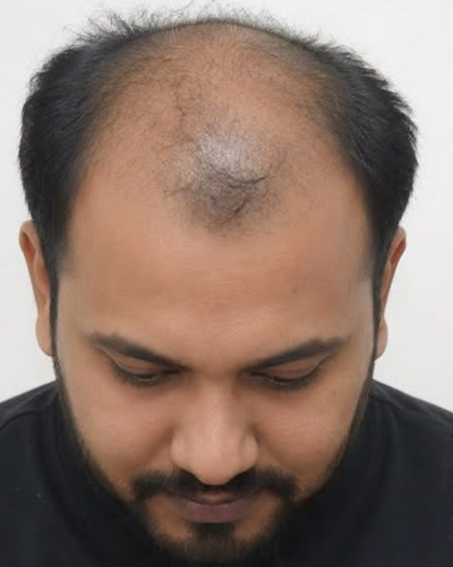 Before, hairline and crown restoration