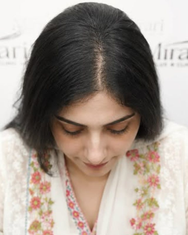 After result, female hair density