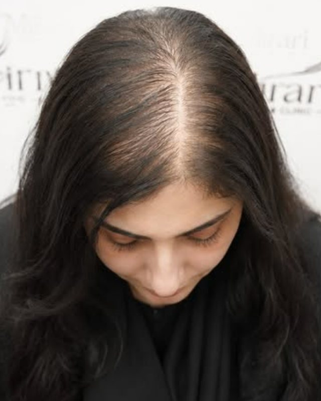 Before, female thinning