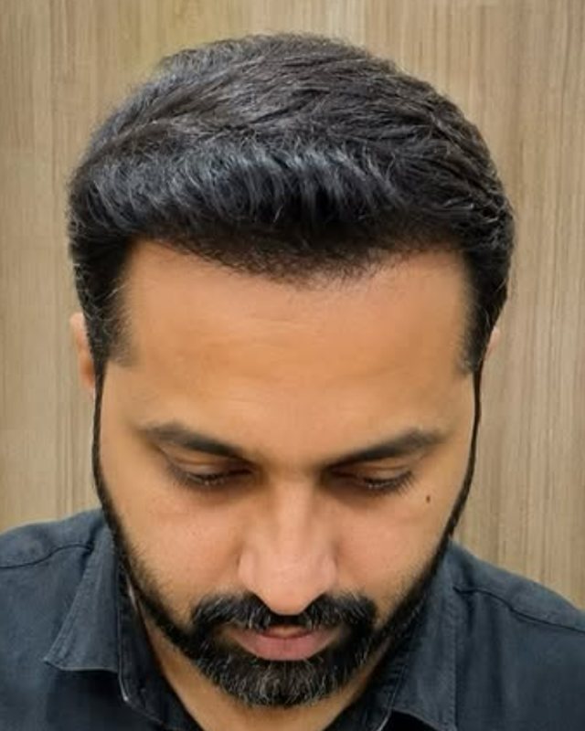 After, crown restoration