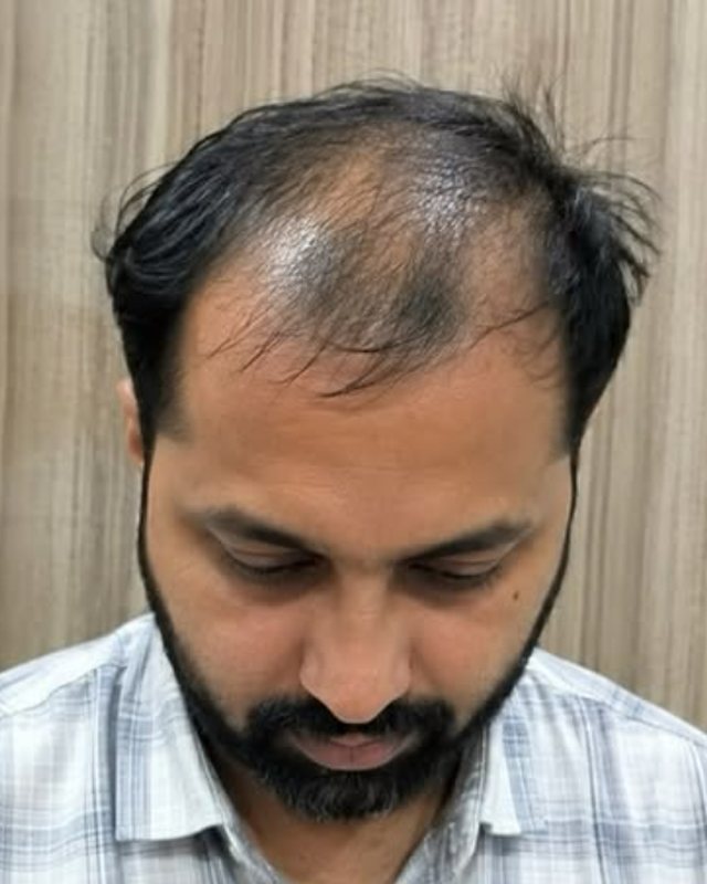 Before, crown restoration