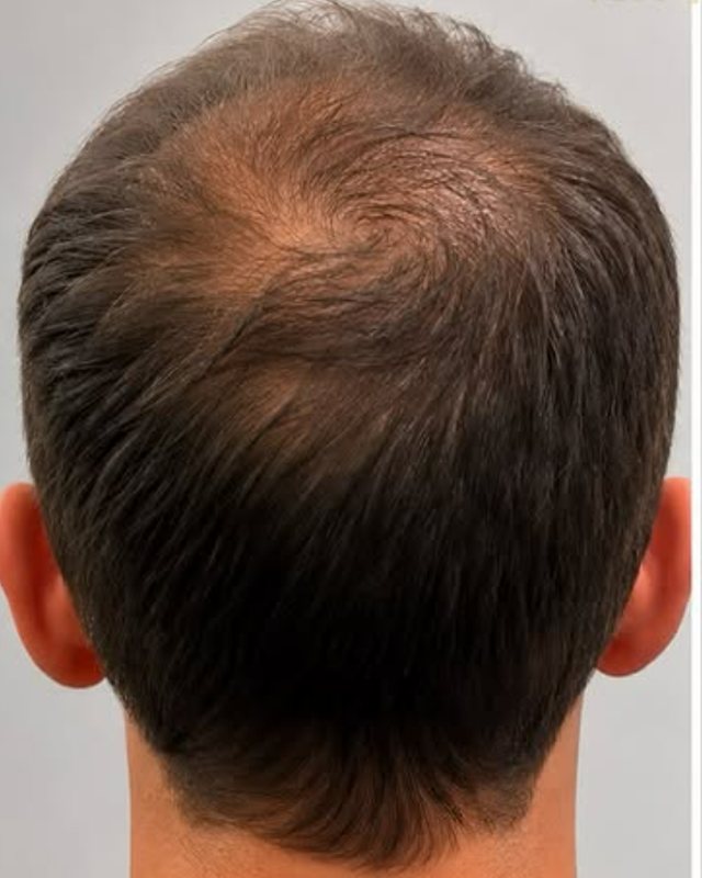 Before, crown