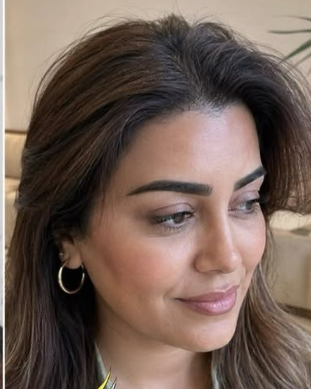 After result, female hairline design