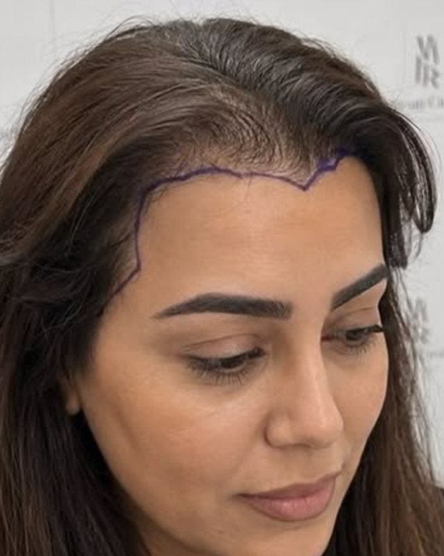 Before, female hairline