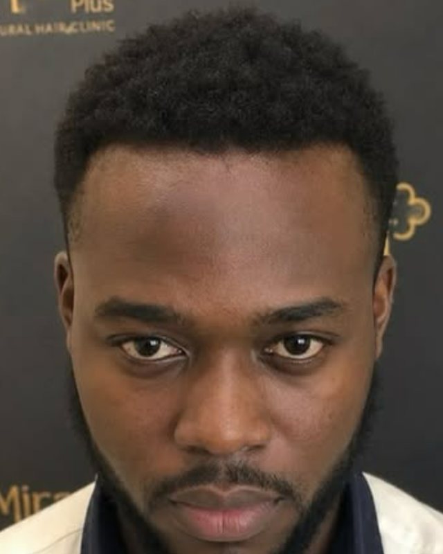 After result, hairline restoration