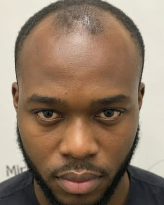 Before, hairline