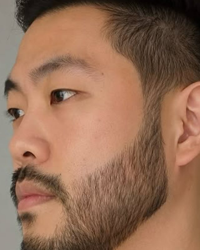 After result, beard transplant