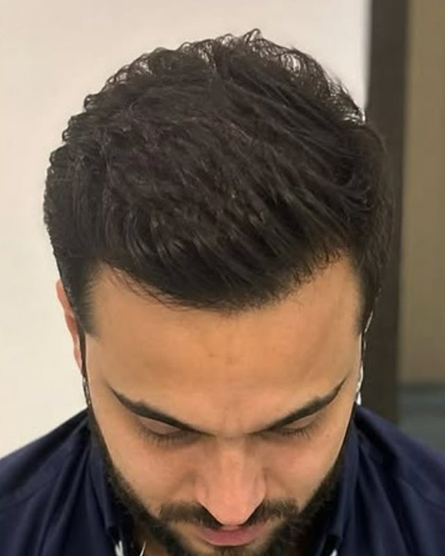 After result, crown and mid-scalp