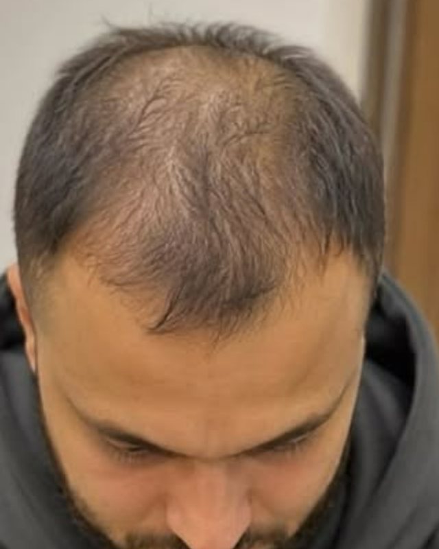Before, crown and mid-scalp